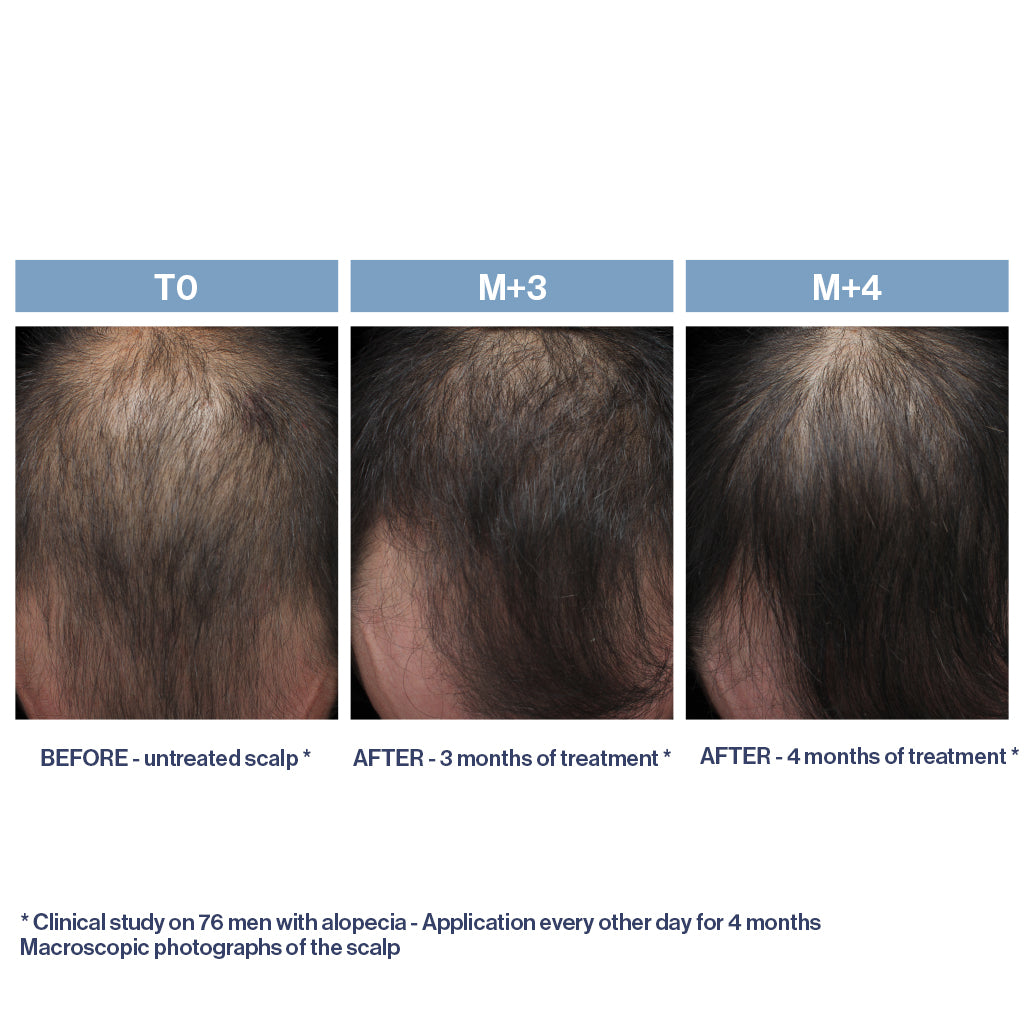 PHYTOLIUM+ Initial Stages Strengthening Treatment